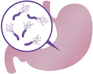 にんいくによる胃潰瘍・十二指腸潰瘍の予防効果